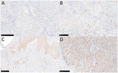 Prognostic and predictive role of YKL-40 in anal squamous cell carcinoma: a serological and tissue-based analysis in a multicentric cohort